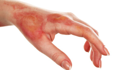 Steps To Take After a Burn Injury